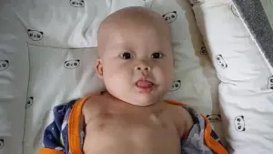 Kisah Chiara: Bayi 8 Bulan Berjuang Melawan Tumor Ganas, Jantung Bocor, dan Down Syndrome